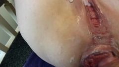 Anal Bitch Receives Dick In Her Big Prolapsed Ass-Hole